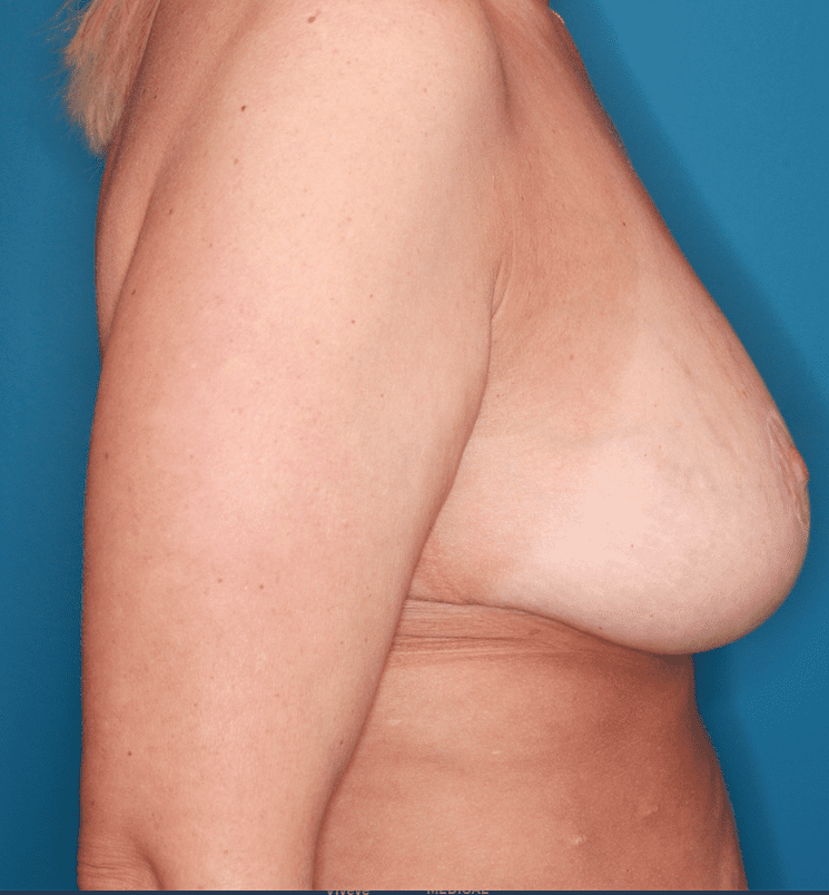Breast Lift Patient Photo - Case 161 - after view-3