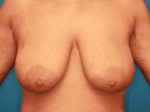 Breast Lift - Case 161 - Before