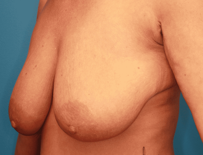 Breast Lift Patient Photo - Case 161 - before view-1