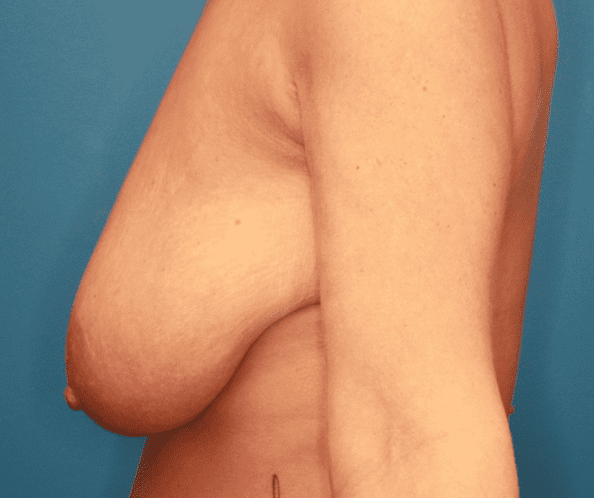 Breast Lift Patient Photo - Case 161 - before view-2