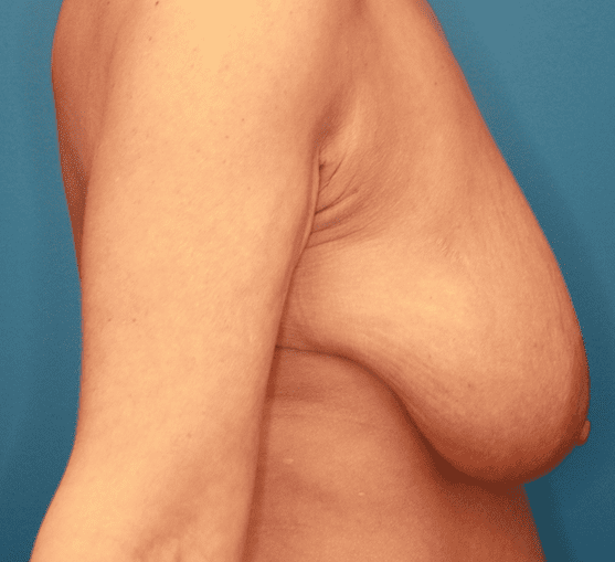 Breast Lift Patient Photo - Case 161 - before view-3
