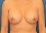 Breast Augmentation - Case 162 - After