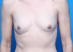 Breast Augmentation - Case 162 - Before