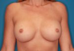 Breast Augmentation - Case 163 - After