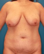 Liposuction - Case 164 - Before