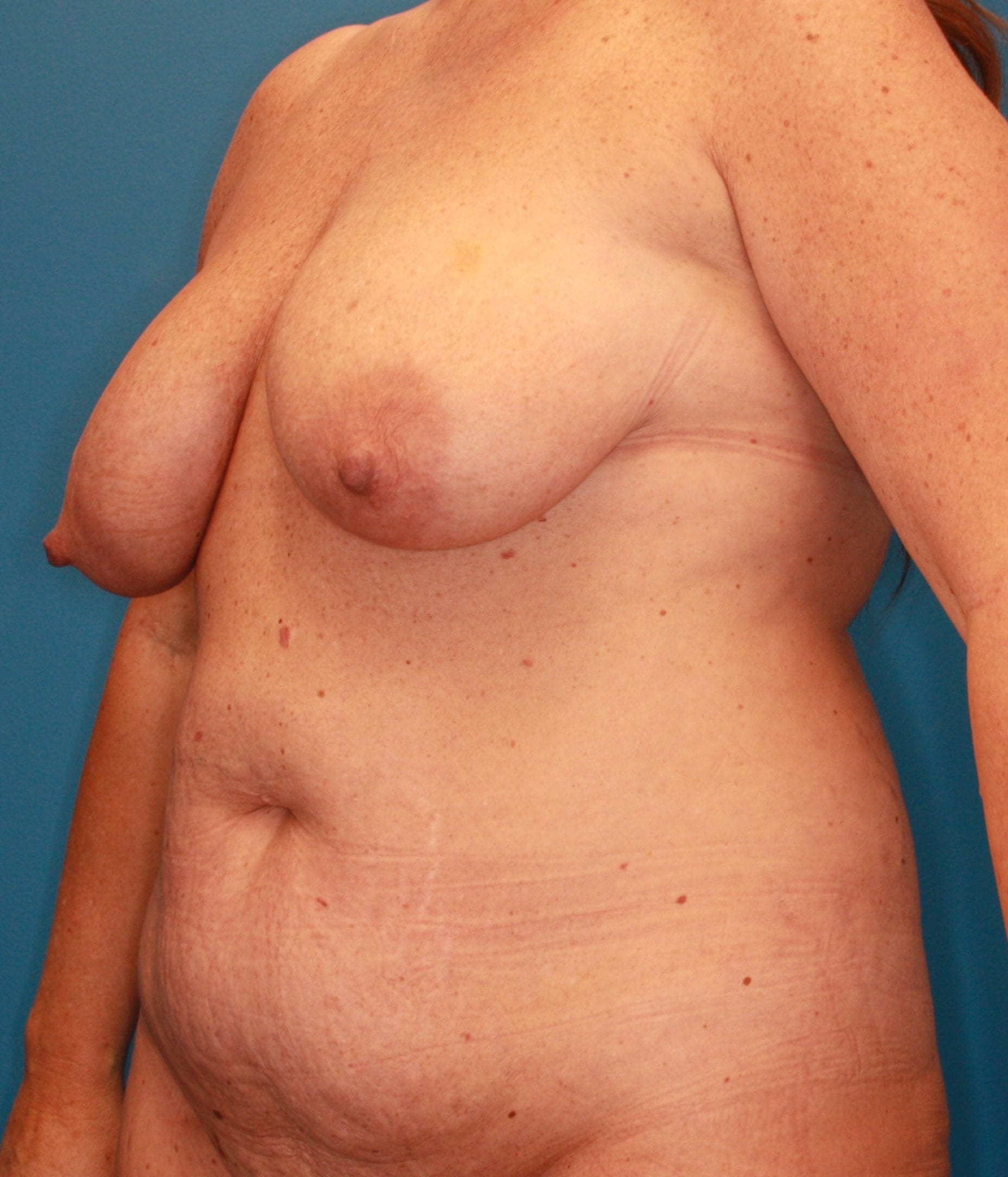 Liposuction Patient Photo - Case 164 - before view-1