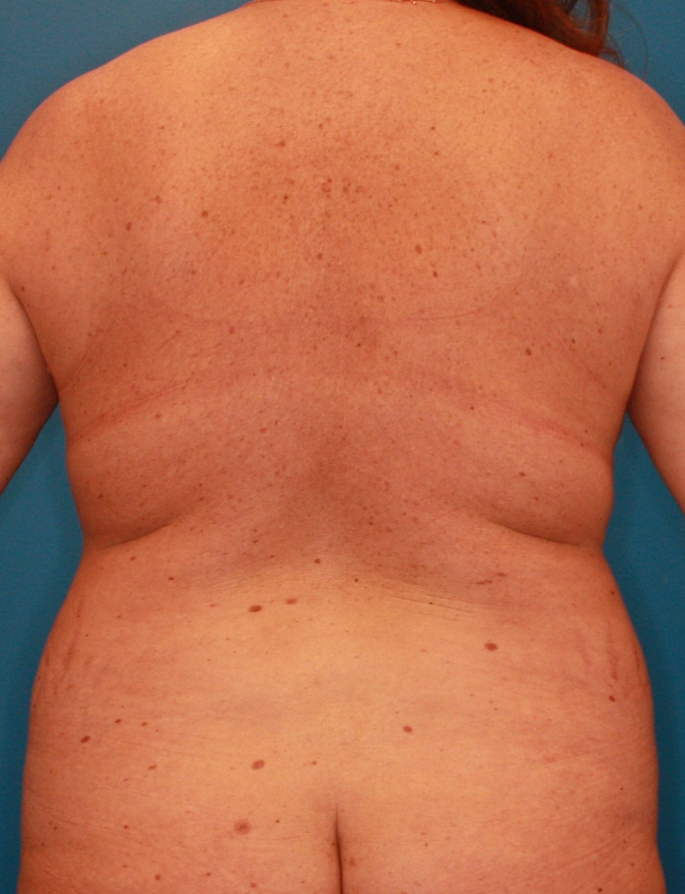 Liposuction Patient Photo - Case 164 - before view-3