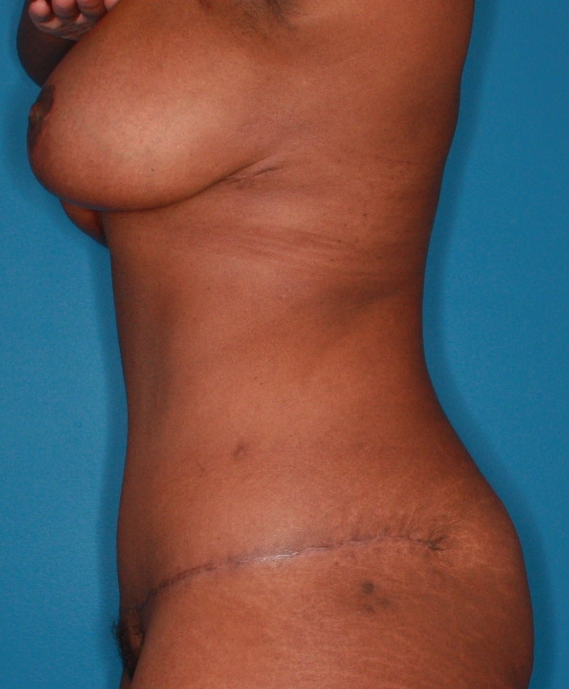 Breast Lift Patient Photo - Case 165 - after view-2
