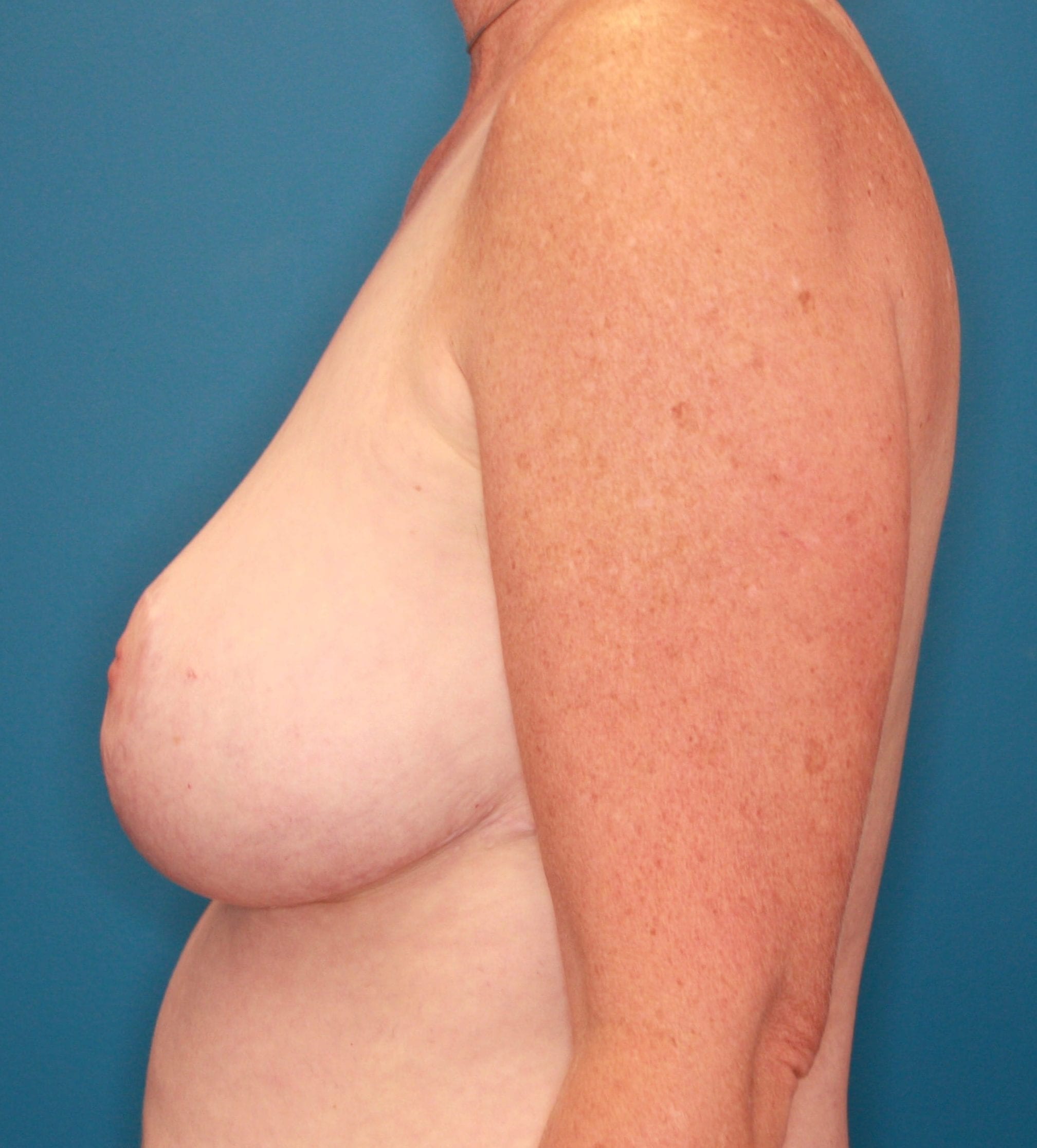 Breast Reduction Patient Photo - Case 168 - after view-2