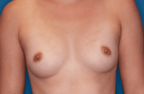 Breast Augmentation Patient Photo - Case 5071 - before view-0