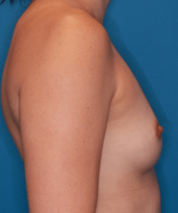 Breast Augmentation Patient Photo - Case 5071 - before view-2