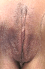 Labiaplasty - Case 5085 - After