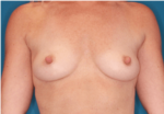 Breast Augmentation - Case 5090 - Before