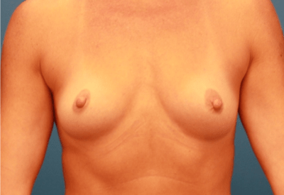 Breast Augmentation Patient Photo - Case 5182 - before view-