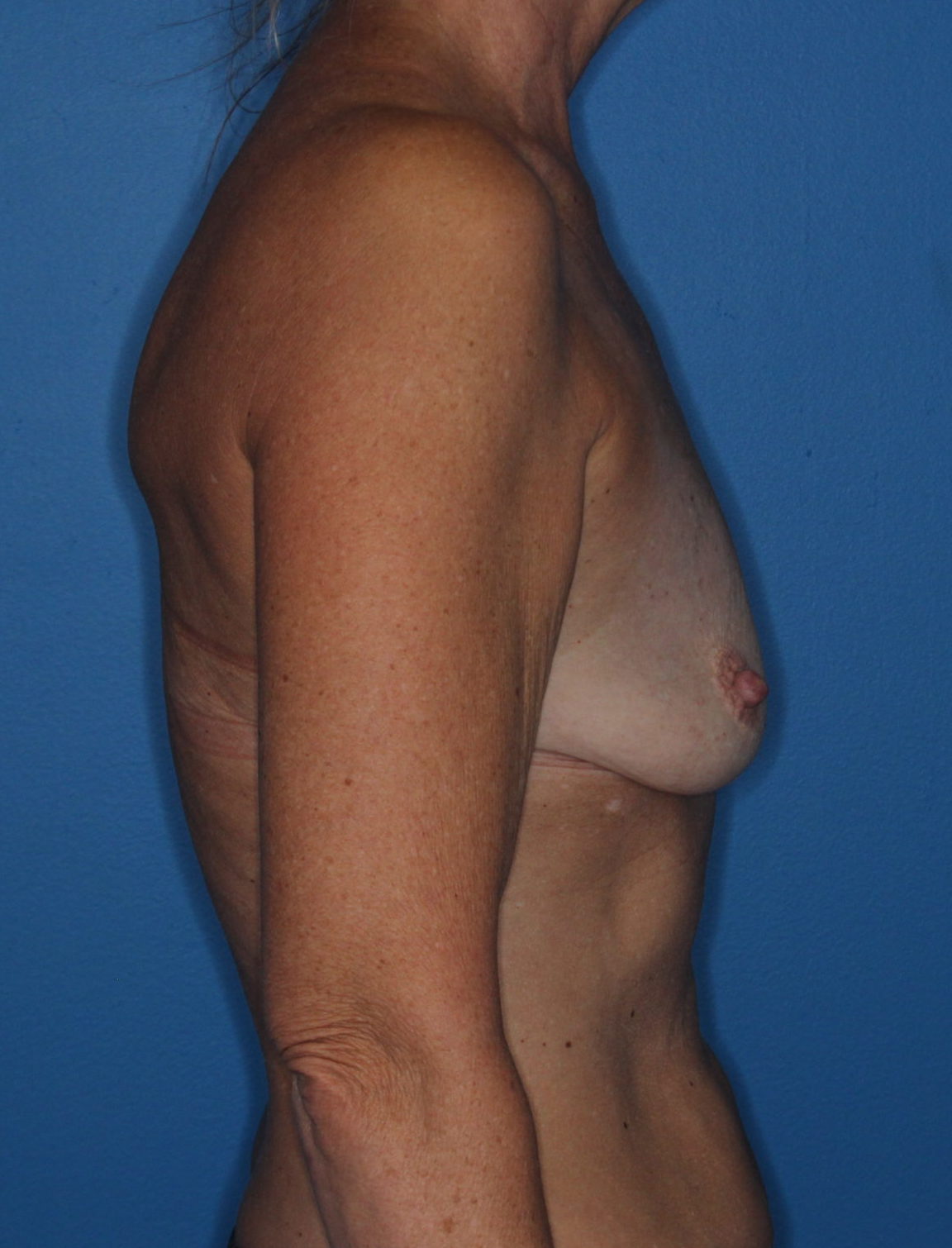 Breast Augmentation Patient Photo - Case 172 - before view-2
