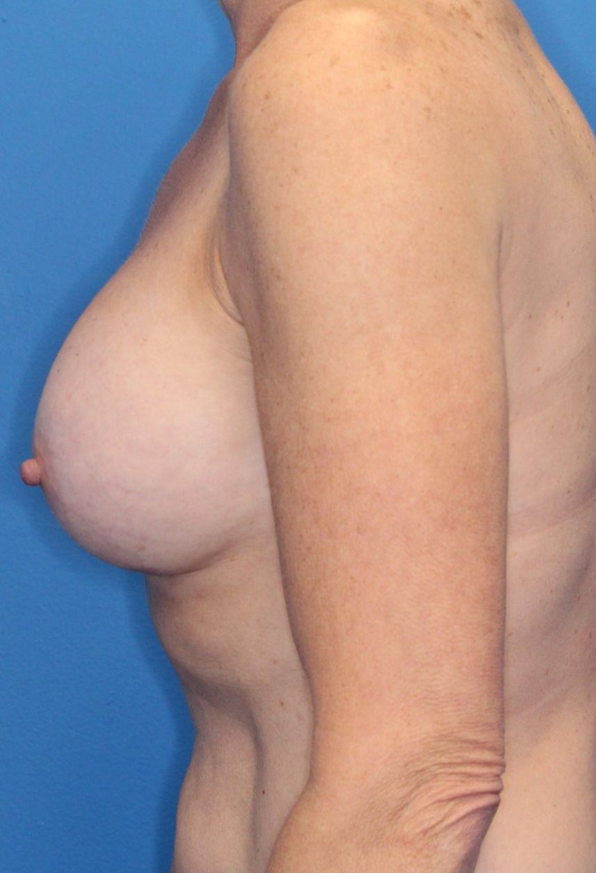 Breast Revision Patient Photo - Case 173 - after view-2