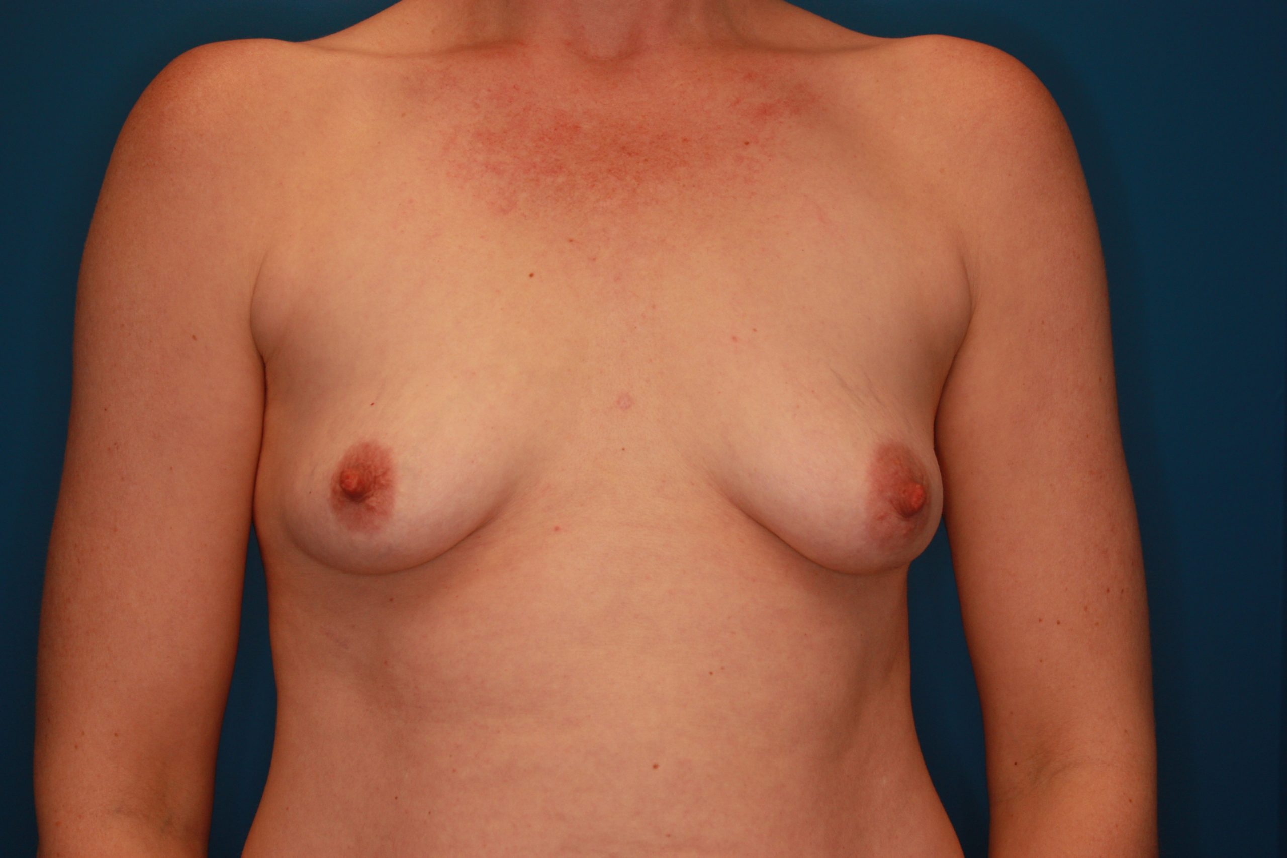 Breast Augmentation Patient Photo - Case 174 - before view-0