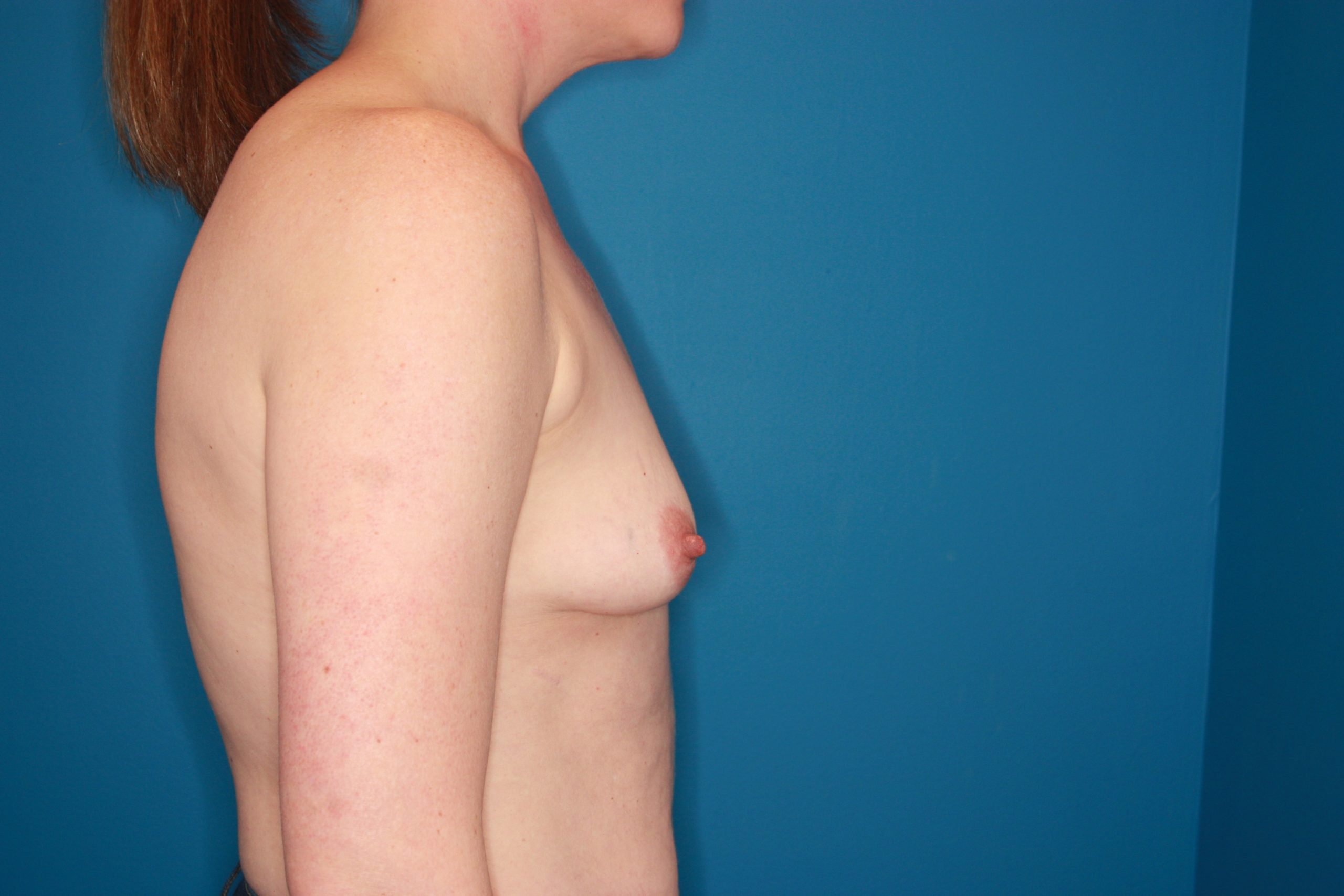 Breast Augmentation Patient Photo - Case 174 - before view-4