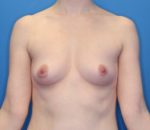 Breast Augmentation - Case 177 - Before