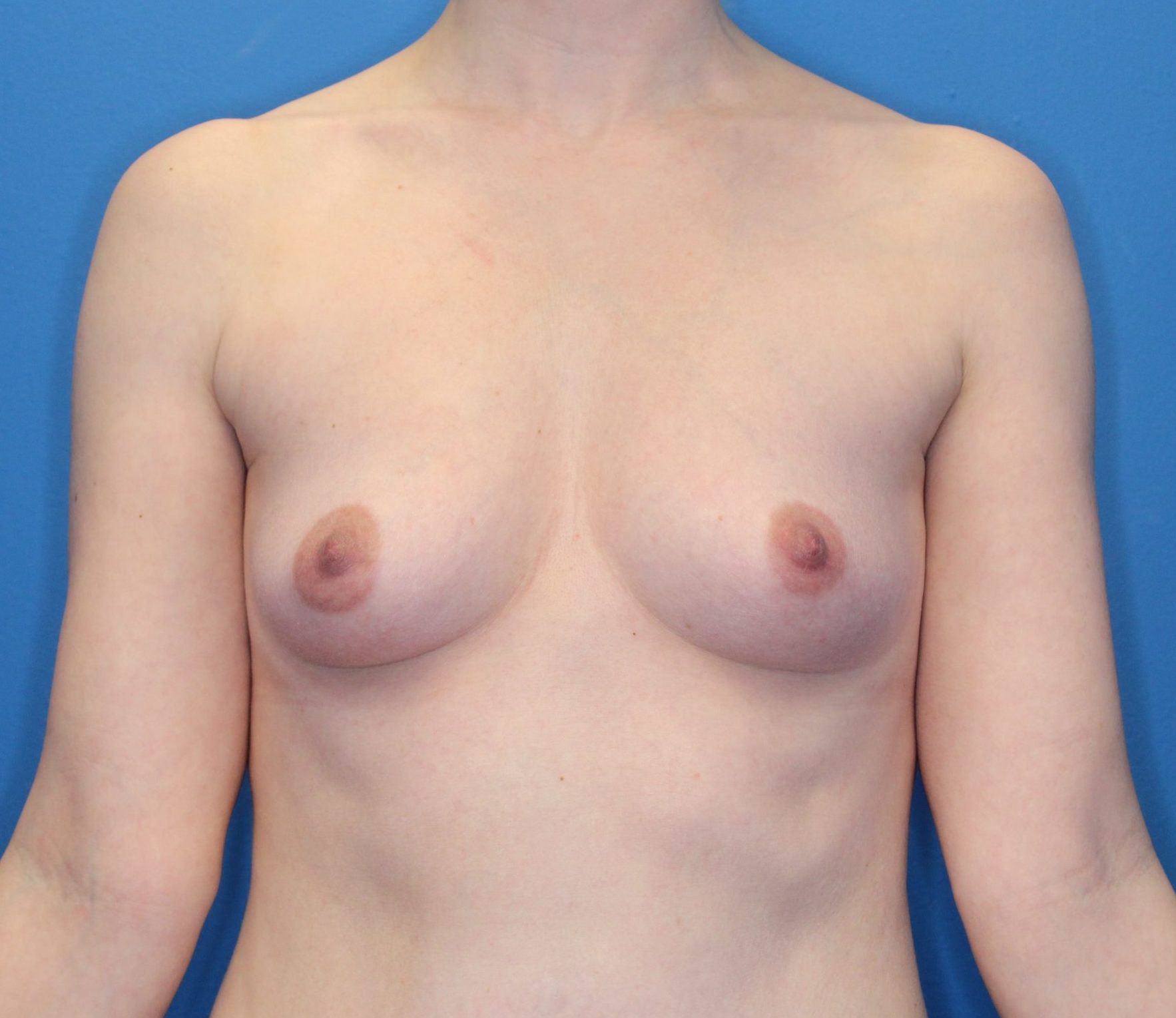 Breast Augmentation Patient Photo - Case 177 - before view-0