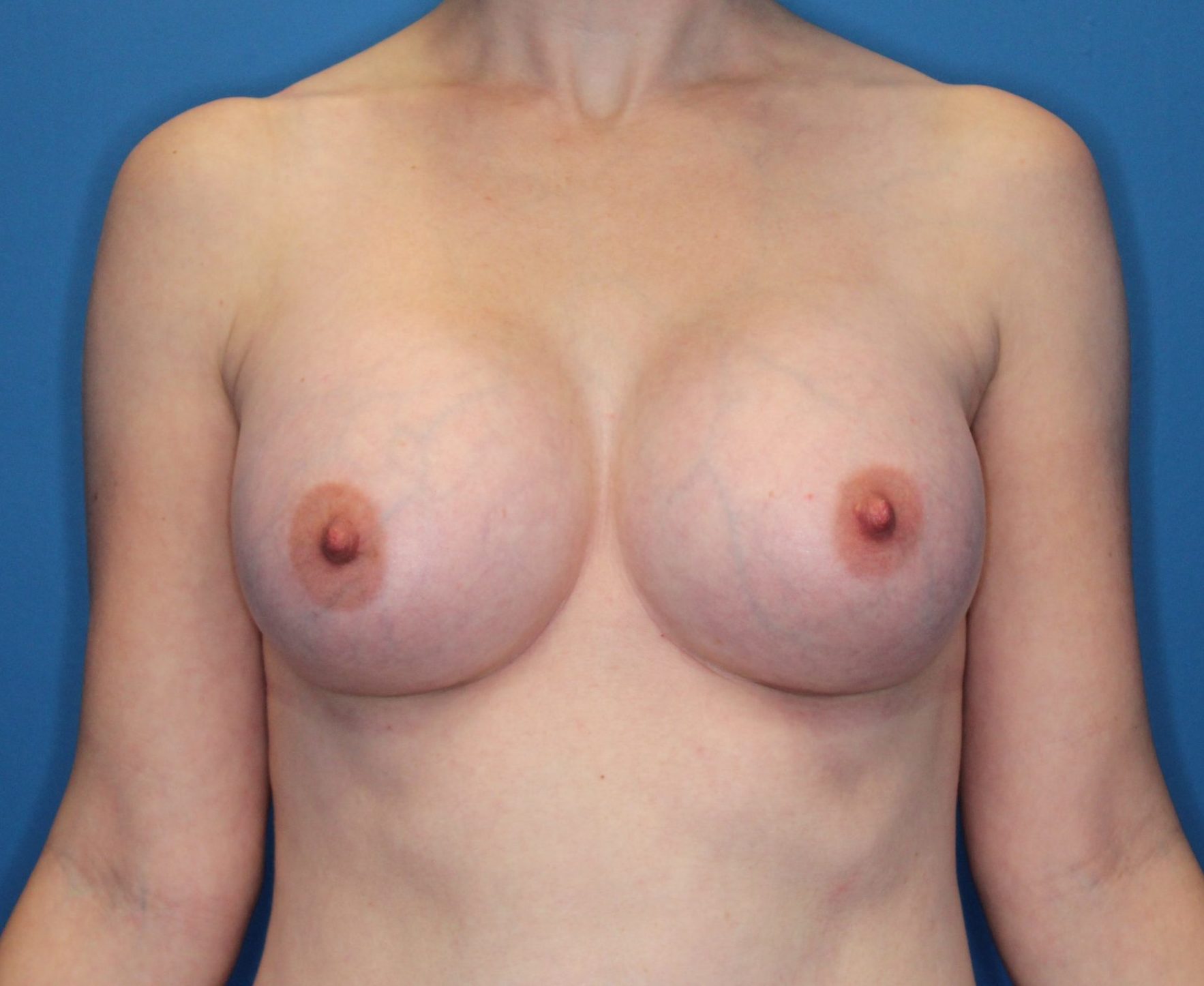 Breast Augmentation Patient Photo - Case 177 - after view-0