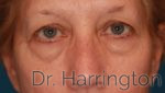 Eyelid Surgery - Case 169 - Before