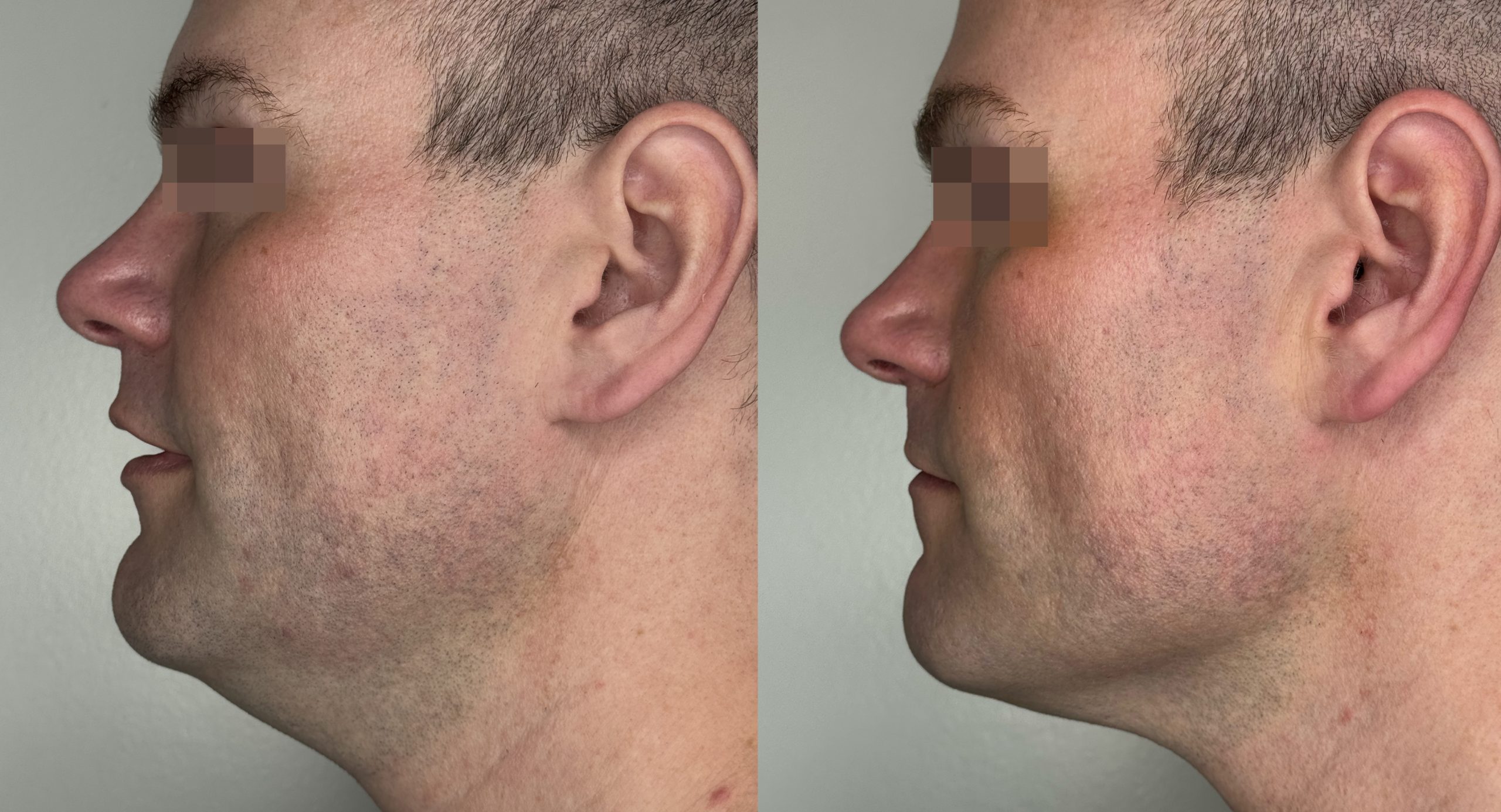 XERF real patient before and after 7