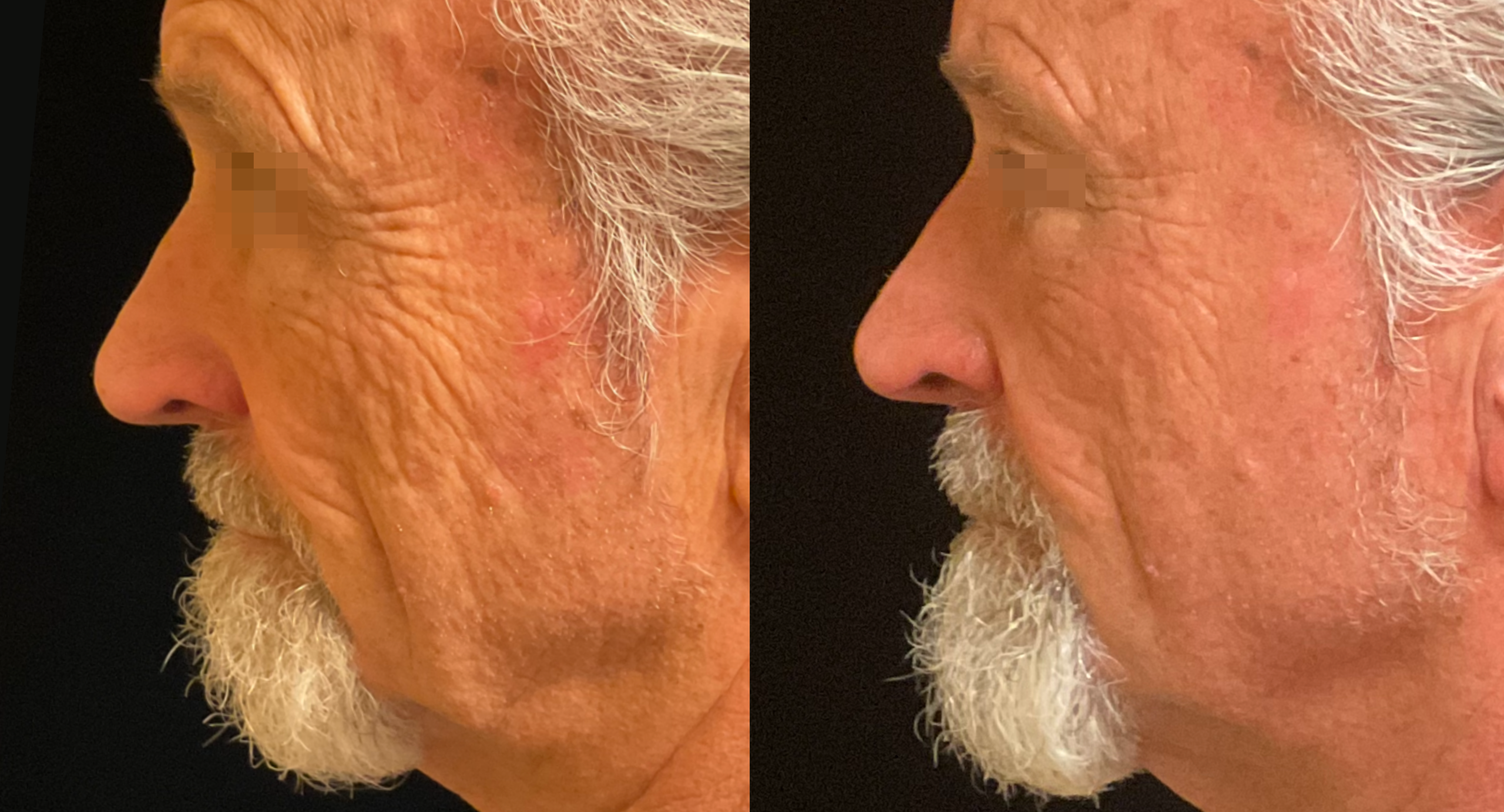 XERF real patient before and after 9