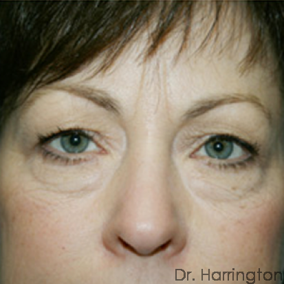 Eyelid Surgery - Case 61 - Before
