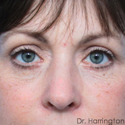 Eyelid Surgery - Case 61 - After