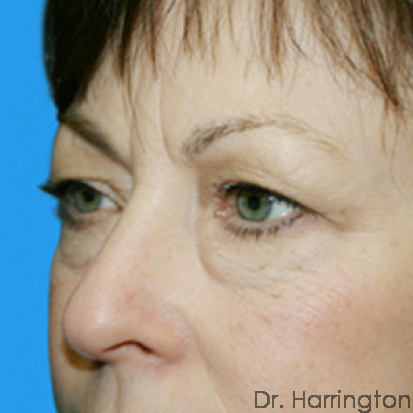 Eyelid Surgery Patient Photo - Case 61 - before view-1