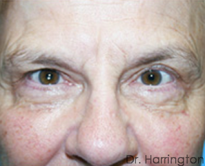 Eyelid Surgery - Case 62 - Before