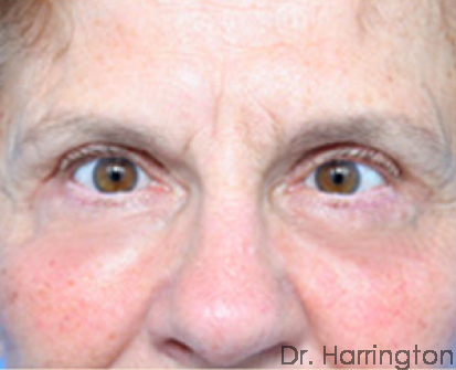 Eyelid Surgery - Case 62 - After