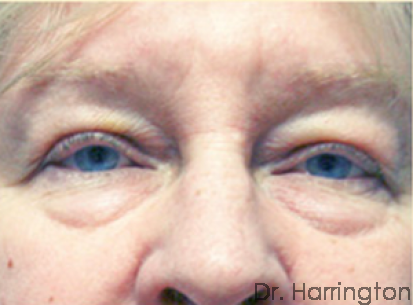 Eyelid Surgery - Case 63 - Before