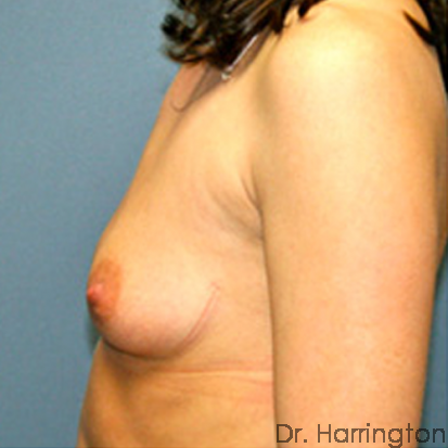 Breast Augmentation Patient Photo - Case 67 - before view-1