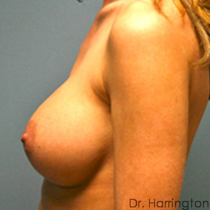 Breast Augmentation Patient Photo - Case 67 - after view-1