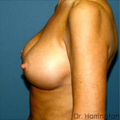 Breast Augmentation Patient Photo - Case 68 - after view-1