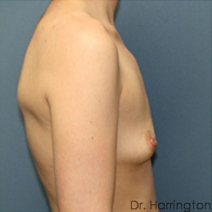 Breast Augmentation Patient Photo - Case 70 - before view-1