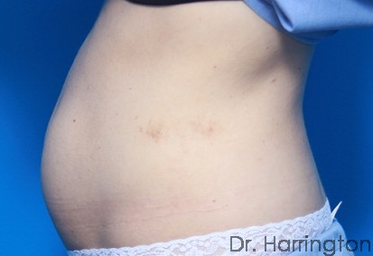 CoolSculpting® - Case 77 - After