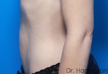 CoolSculpting® Patient Photo - Case 77 - after view-1