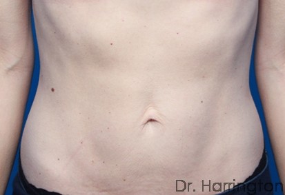 CoolSculpting® - Case 77 - Before