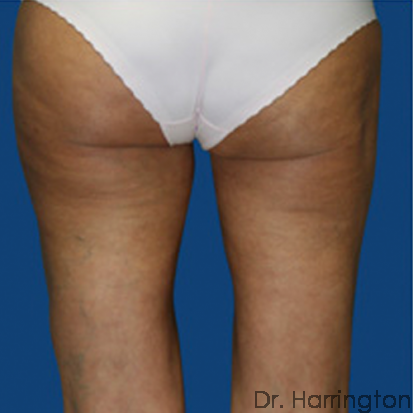 Liposuction Patient Photo - Case 81 - after view-1