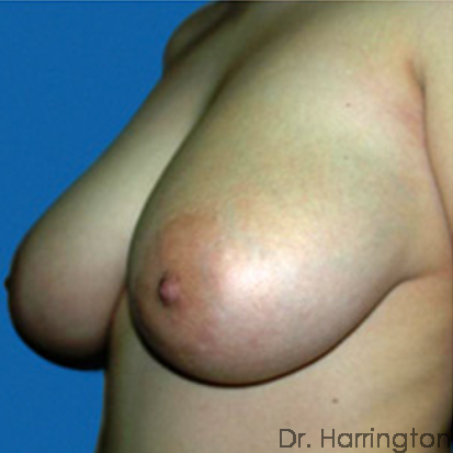 Breast Reduction Patient Photo - Case 75 - before view-1