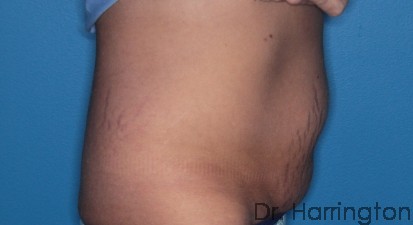 CoolSculpting® - Case 90 - Before