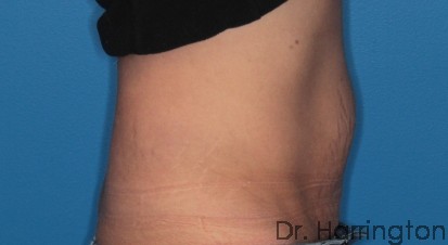 CoolSculpting® - Case 90 - After
