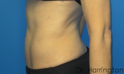 CoolSculpting® Patient Photo - Case 91 - after view-1