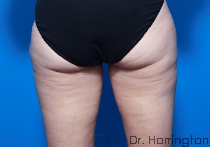 CoolSculpting® - Case 91 - Before