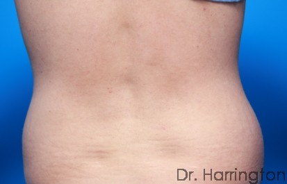 CoolSculpting® - Case 93 - Before