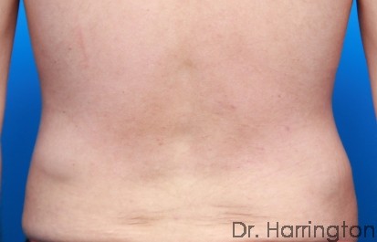 CoolSculpting® - Case 93 - After