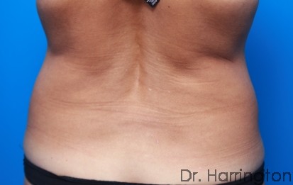 CoolSculpting® - Case 94 - Before